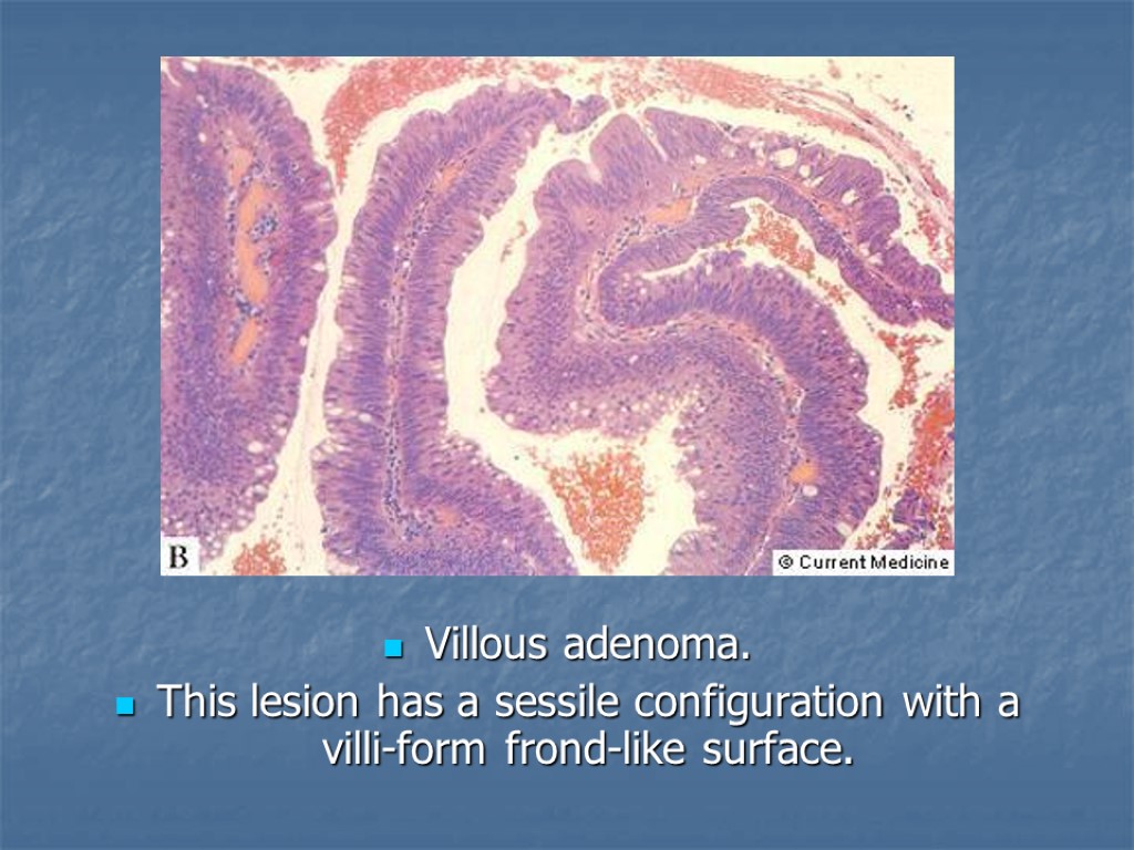 Villous adenoma. This lesion has a sessile configuration with a villi-form frond-like surface.